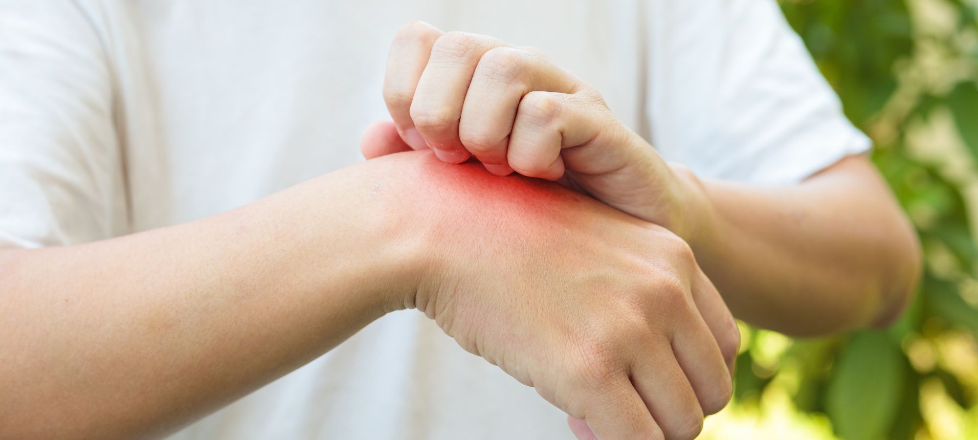 Person with an insect bite