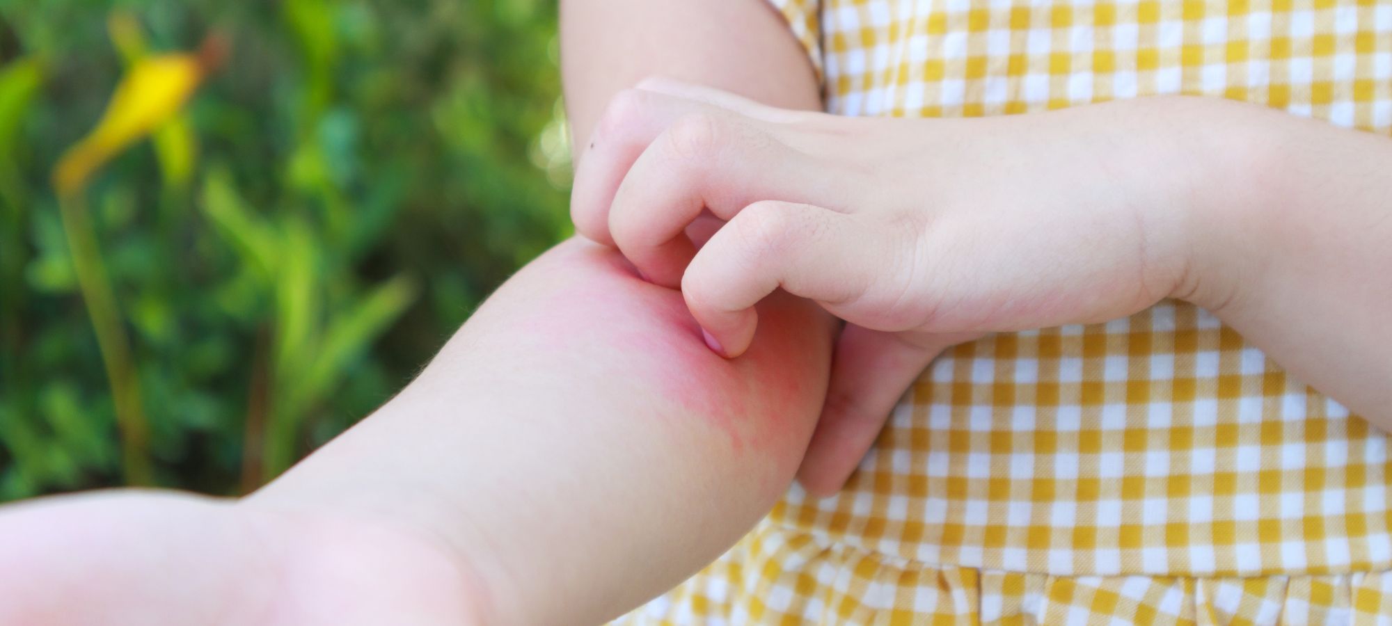 Lady with Shingles